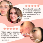 Acne Cleanse – Complément Peau Nette – 90 Capsules – Formule aux Extraits de Plantes (Hamamélis, Saule Blanc) et Vitamines A & C – Aide à Réduire l'Acné et les Imperfections – Cure de 3 mois – Image 3