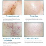 Lotion Tonique Purifiante Acne Clear – Traitement Rapide à l'Acide Salicylique – Élimine l'Acné, Réduit les Marques et Nettoie les Pores – Teint Éclatant et Hydraté – 100ml – Image 2