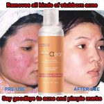 Lotion Tonique Purifiante Acne Clear – Traitement Rapide à l'Acide Salicylique – Élimine l'Acné, Réduit les Marques et Nettoie les Pores – Teint Éclatant et Hydraté – 100ml – Image 3