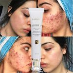 Crème de Réparation Intensive : Vergetures, Cicatrices, Chéloïdes et Marques d'Acné (30g) – Image 2