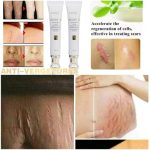 Crème de Réparation Intensive : Vergetures, Cicatrices, Chéloïdes et Marques d'Acné (30g) – Image 5