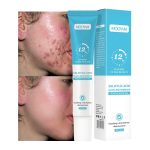 Gel Anti-Acné MOÔYAM à l'Acide Salicylique – Élimination Rapide, Action Apaisante et Anti-Rougeurs 12H – 20g