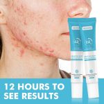 Gel Anti-Acné MOÔYAM à l'Acide Salicylique – Élimination Rapide, Action Apaisante et Anti-Rougeurs 12H – 20g – Image 2
