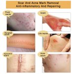 Gel Réparateur ALIVER TCM – Soin Anti-Cicatrices et Marques d’Acné – Anti-inflammatoire et Régénérant - DR – Image 5